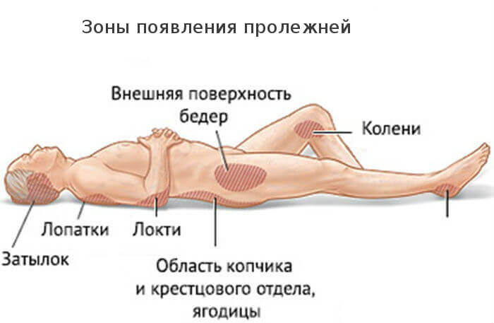 Зоны появления пролежней